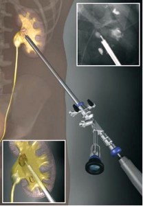 Чрескожная нефролитотрипсия
