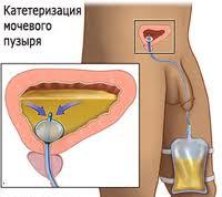 Установка катетера