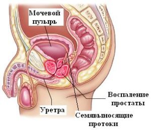 розвивається простатит, розвивається простатит,