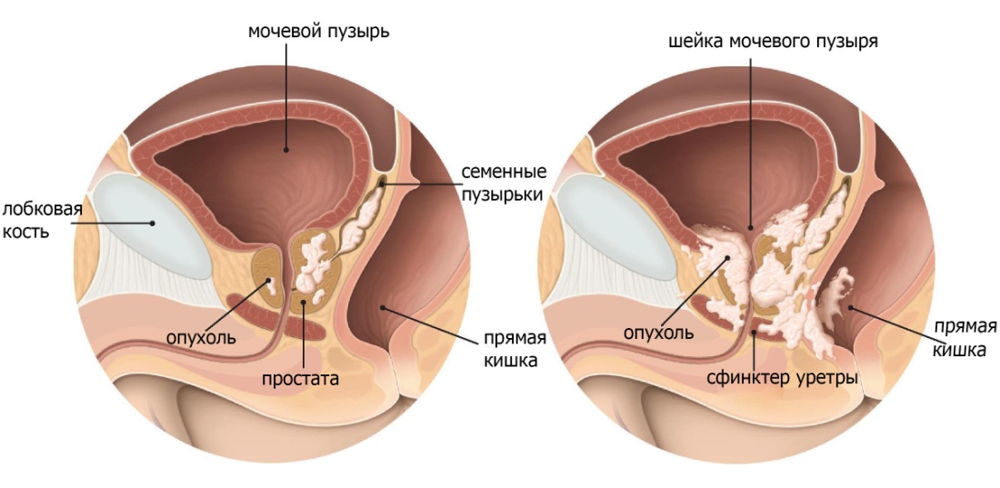Для чого робиться Біопсія простати