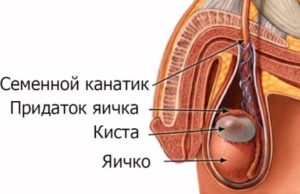 Кіста придатка яєчка
