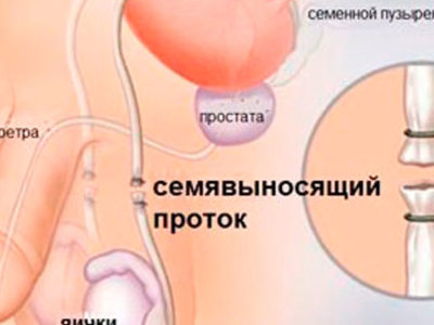 Вазэктомия стерилизация мужская в Николаеве фото