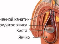 Удаление кисты придатка в Николаеве фото