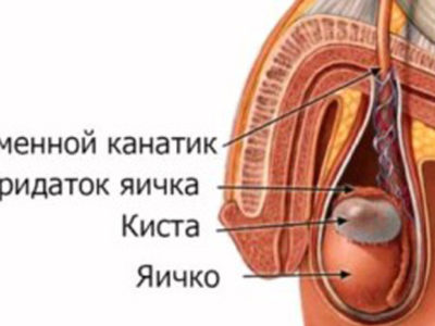 Удаление кисты придатка в Николаеве фото