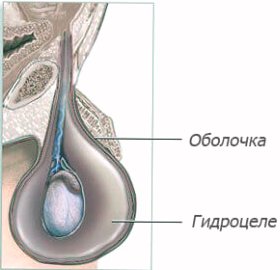 Гідроцелє Гідроцелє