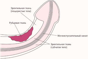 Фіброз кавернозних тел
