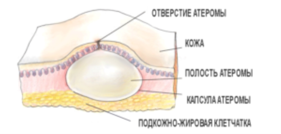 Жировики на мошонці (Атерома, ліпома) 