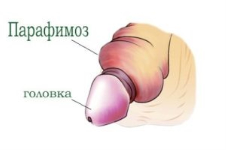 фімоз і парафімоз. фімоз і парафімоз.