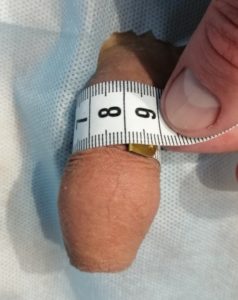 Клінічний випадок Потовщення члена гіалуроновою кислотою. Клінічний випадок Потовщення члена гіалуроновою кислотою.