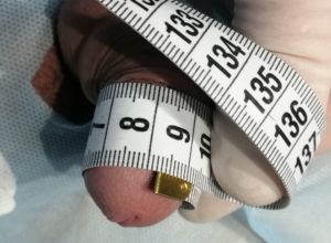 Клінічний випадок Потовщення члена гіалуроновою кислотою. Діаметр головки члена склав 8.2 сантиметри