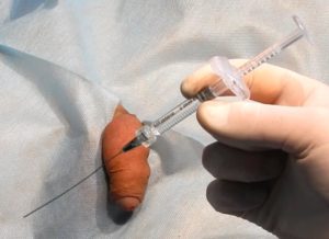 Клінічний випадок Потовщення члена гіалуроновою кислотою. Потовщення члена гіалуроновою кислотою проводилося з одного проколу біля лобка