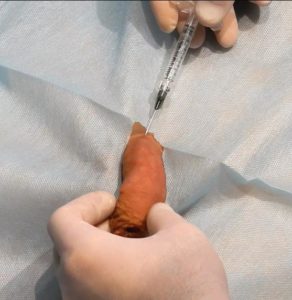 Клінічний випадок Потовщення члена гіалуроновою кислотою. введения канюли под кожу пениса