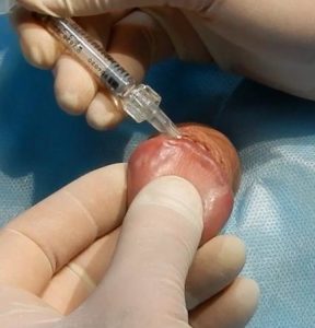 Збільшення головки гіалуроновою кислотою Збільшення головки гіалуроновою кислотою