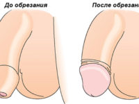 обрезание крайней плоти в Николаеве фото